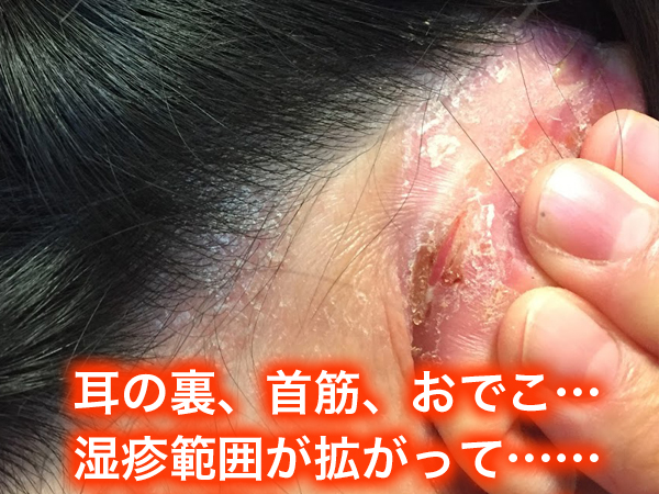 耳の裏、首筋、おでこ、脂漏性皮膚炎・頭皮湿疹